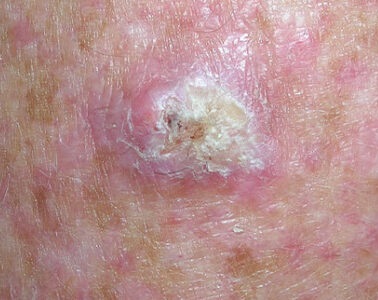 Squamous cell carcinoma on the forearm showing a thick, white-yellow keratin crust over a raised pink lesion on chronically sun-damaged skin