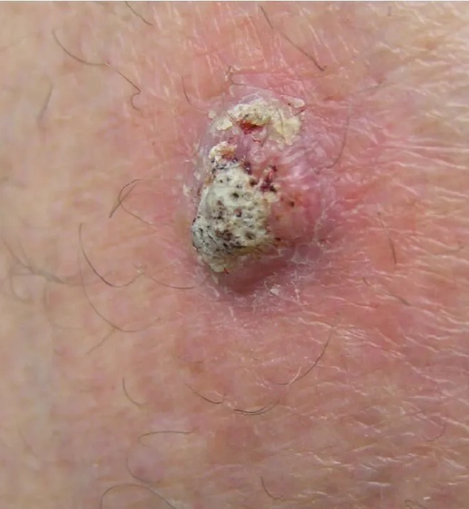 Squamous cell carcinoma on the back showing a raised pink nodule with adherent thick white-grey keratin scale and surrounding erythema — non-healing crusted lesion
