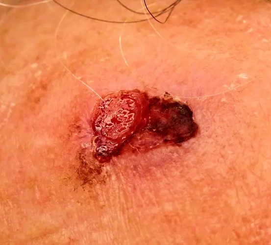 Advanced ulcerated squamous cell carcinoma showing a raised red strawberry-like nodule with bleeding crusted ulceration on chronically sun-damaged skin