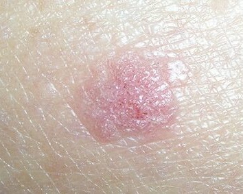 Early squamous cell carcinoma on the chest appearing as a small raised pink scaly plaque with a rough surface — often mistaken for a wart or dry patch
