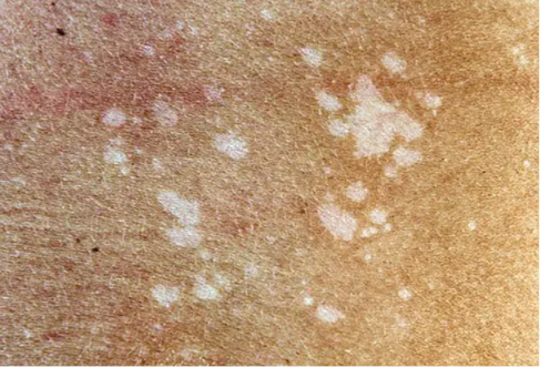 White spots on skin — small pale patches on sun-exposed skin.
