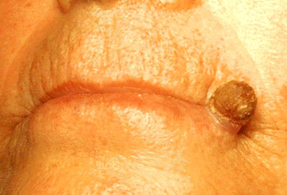 Clinical photo of actinic keratosis on the lower lip showing a rough, scaly patch on sun-damaged skin
