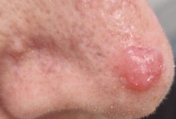 Close-up clinical photo of a small pink, dome-shaped nodule on the side of the nose with a smooth shiny surface and visible fine blood vessels — the typical appearance of an amelanotic (non-pigmented) skin lesion