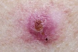 Clinical photo of a basal cell carcinoma — a pearly, translucent nodule with visible fine blood vessels