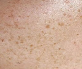 Close-up of fair skin covered with dozens of small, uniform tan-brown freckles (ephelides) on a sun-exposed area