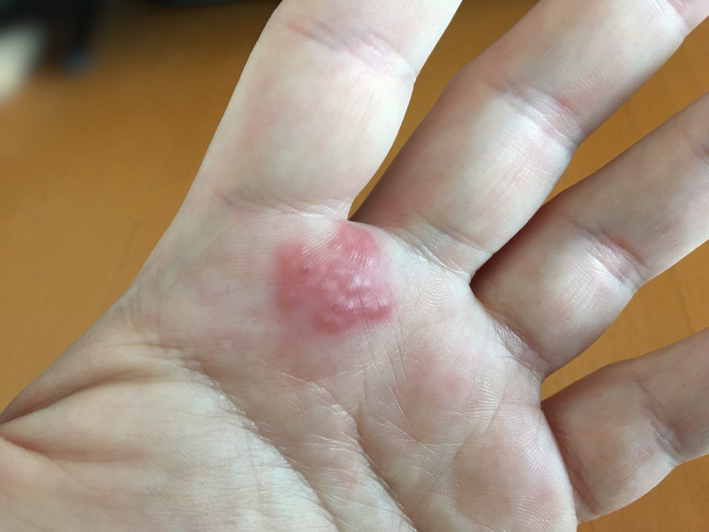 Clinical photo of contact dermatitis — red, itchy patches with a clearly demarcated edge on the skin.