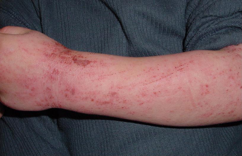 Clinical photo of atopic dermatitis (eczema) on a child — dry, red, scaly itchy patches on skin.
