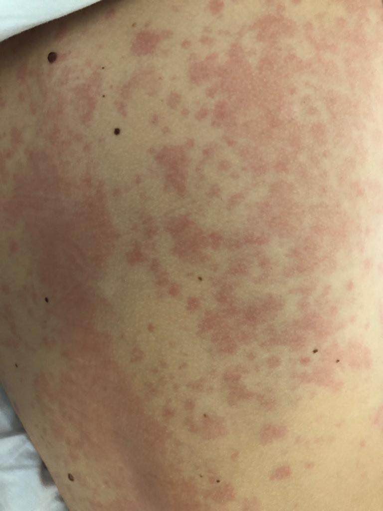 Clinical photo of urticaria (hives) — raised pale-pink itchy welts (wheals) on the skin.