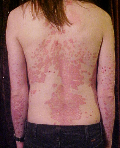 Clinical photo of plaque psoriasis on the back — well-defined thick pink-red plaques with silvery scale.