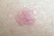 Close-up clinical photo of an early squamous cell carcinoma — a pink, scaly, crusted plaque with a slightly raised border on sun-exposed skin