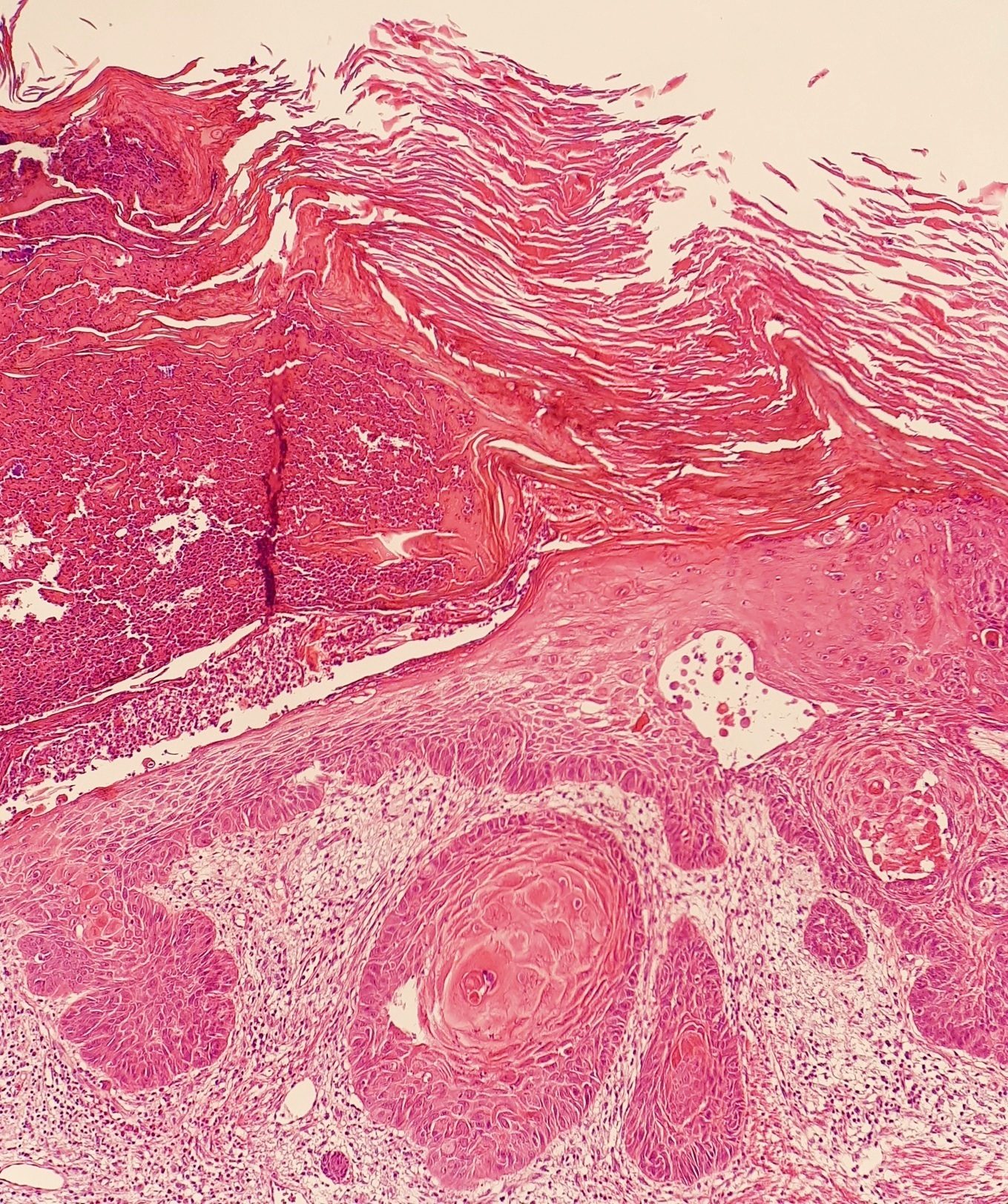 Clinical photo of a non-healing squamous cell carcinoma showing an ulcer with a raised, rolled border on sun-damaged skin