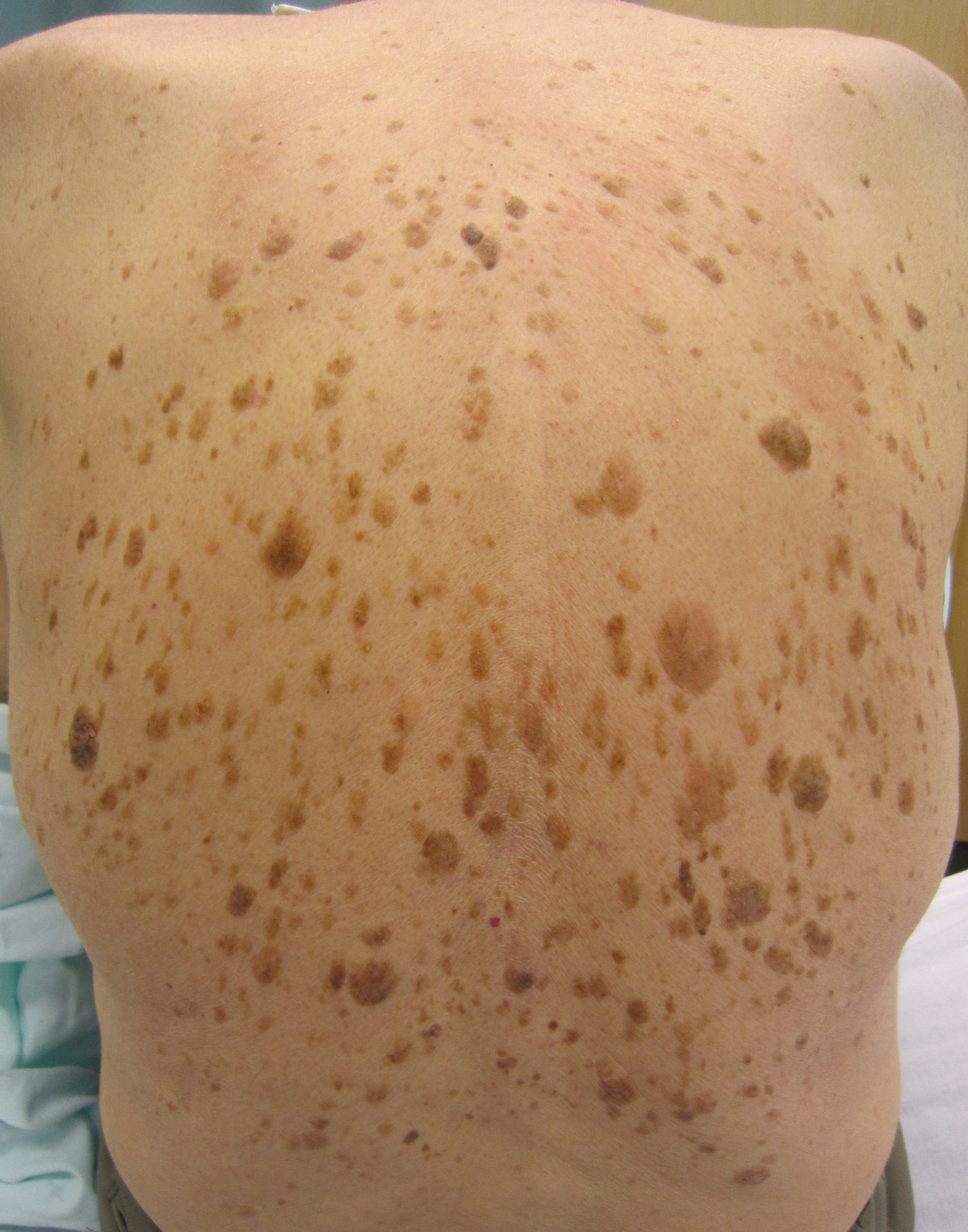 Clinical photo of multiple seborrheic keratoses on the back — waxy, well-defined, stuck-on brown papules