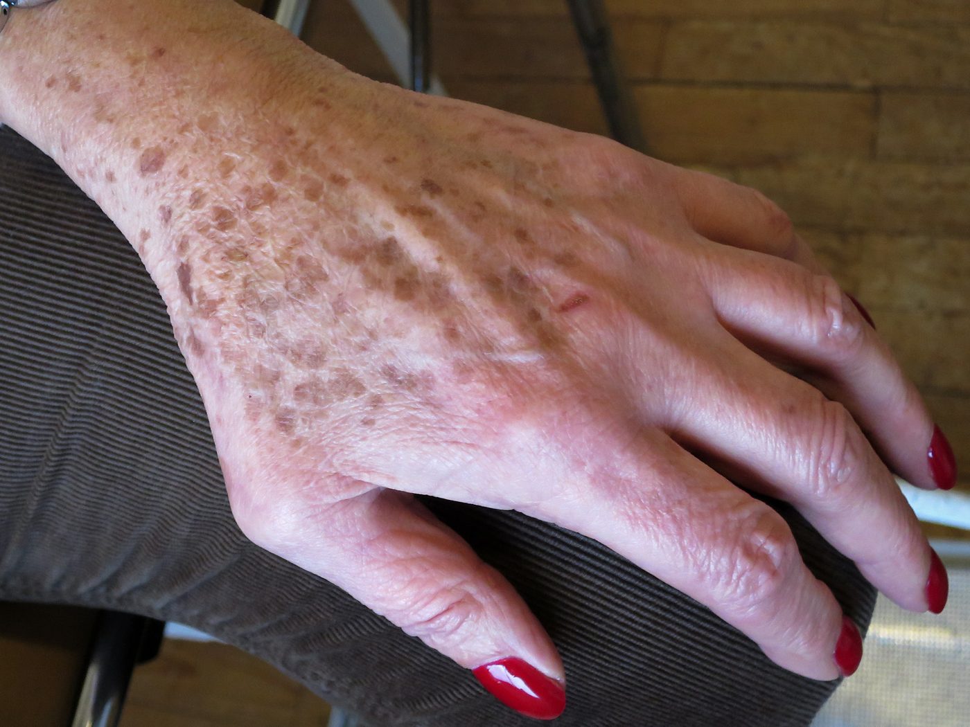 Clinical photo of a solar lentigo (age spot) — a flat, uniformly pigmented brown spot on sun-exposed skin.