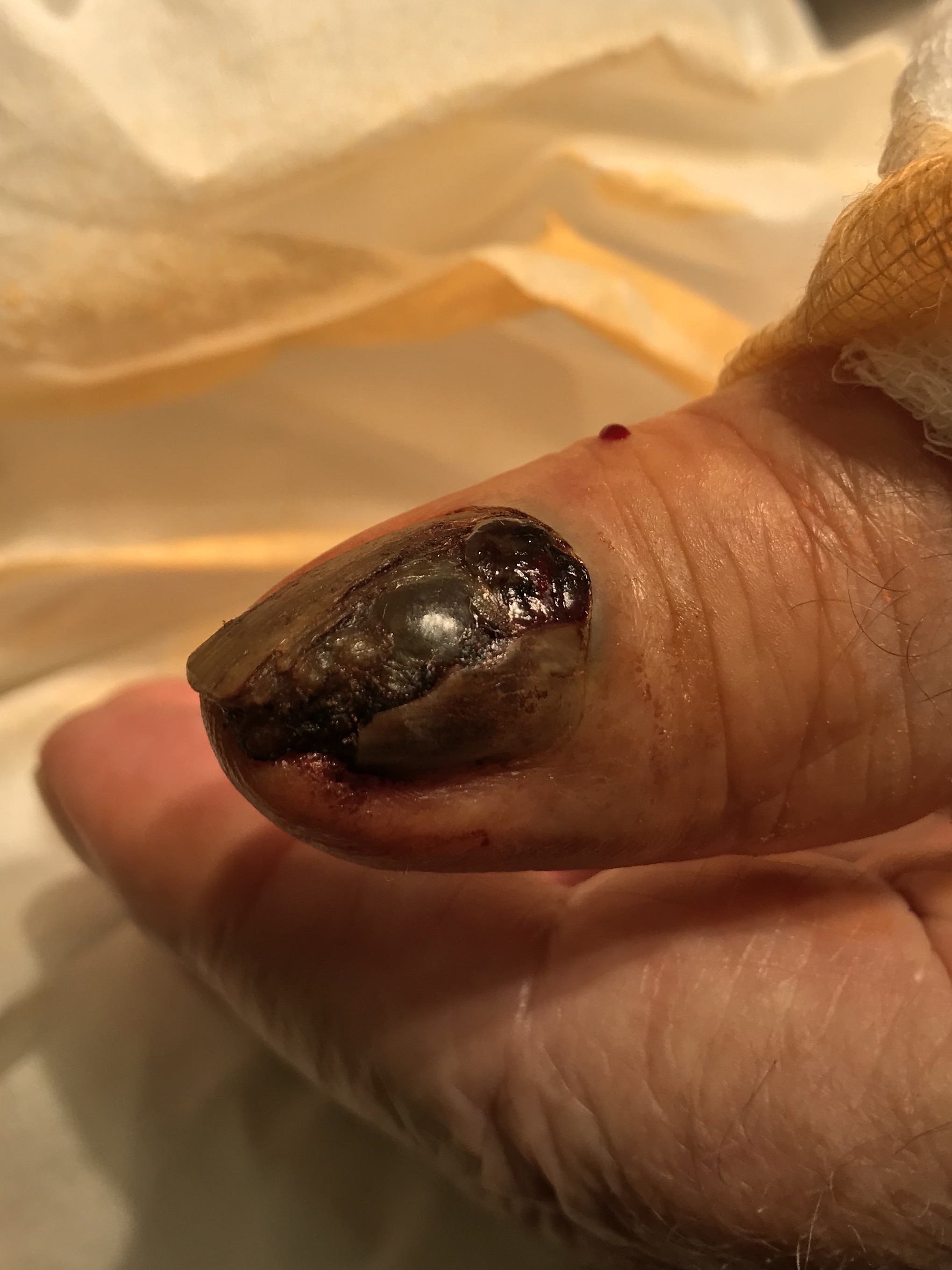 Clinical photo of melanoma of the thumb showing a pigmented nail lesion